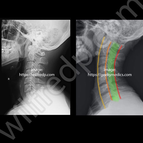 頸椎生理曲度(1) :: WilfredP