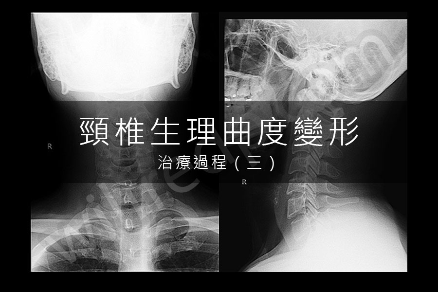 頸椎生理曲度變形 / Military Neck 治療記錄 :: WilfredP