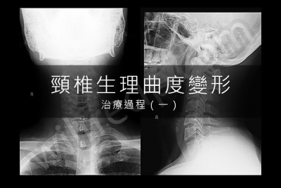頸椎生理曲度變形治療記錄（一）